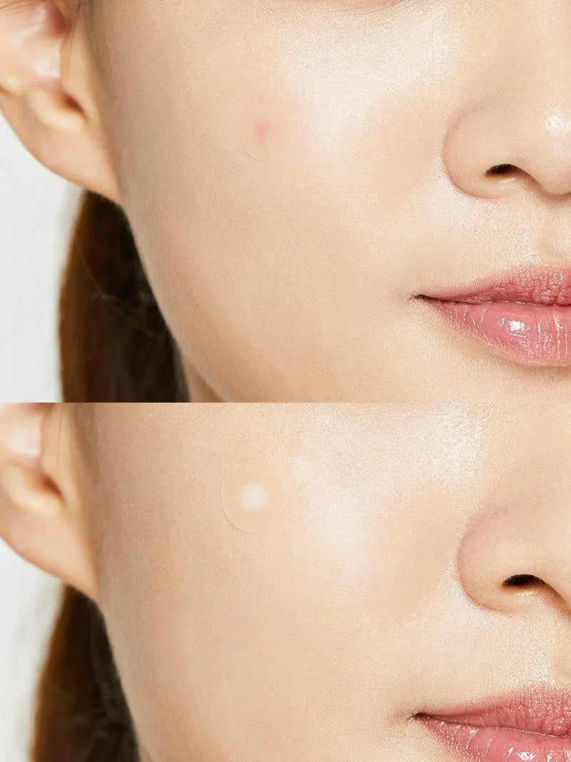 COSRX Acne Pimple Master Patch (24EA) - Skin Muse